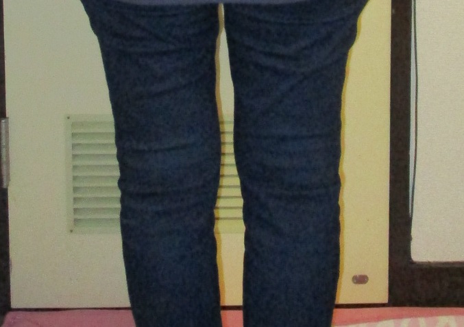 整体前の膝のむくみ