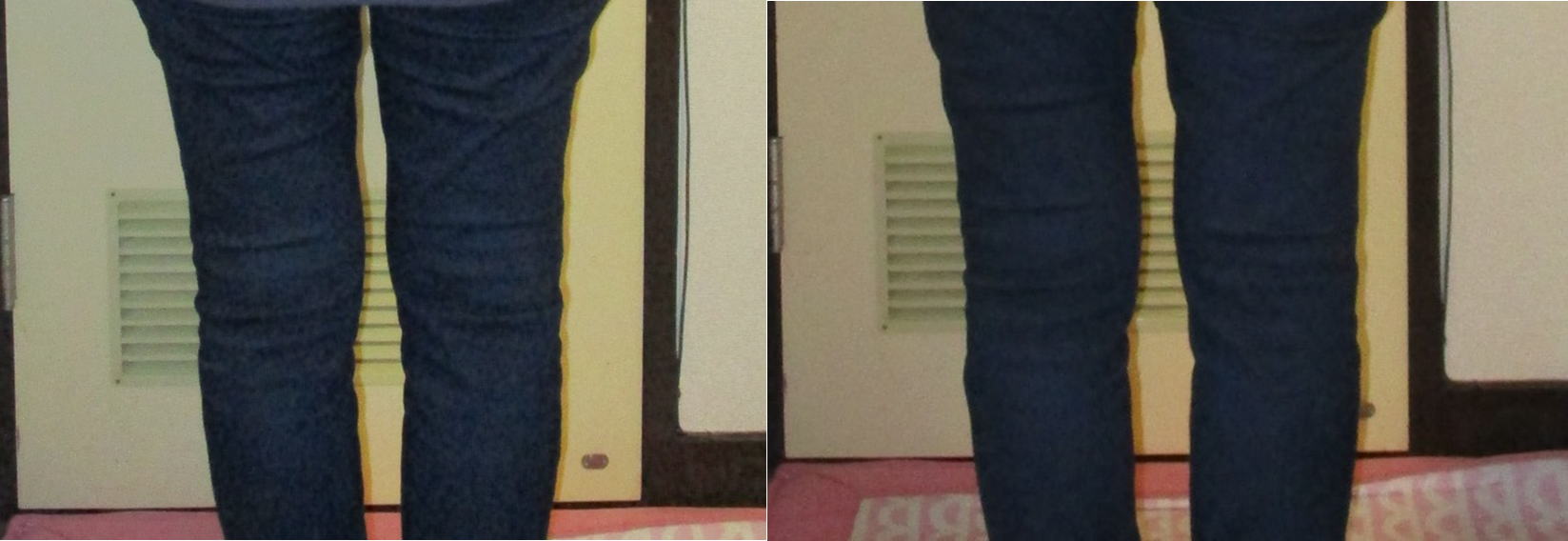 整体前後の膝のむくみ比較