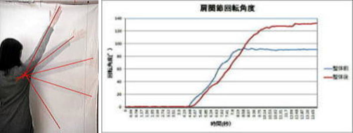 五十肩の可動域の測定。