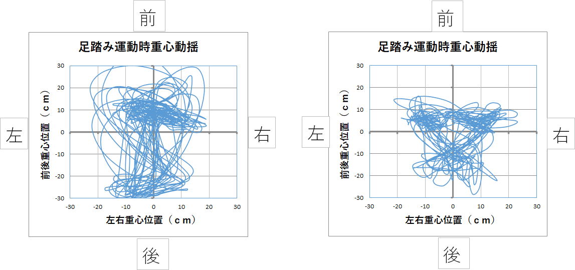 坐骨神経痛を床面重心バランスで確認